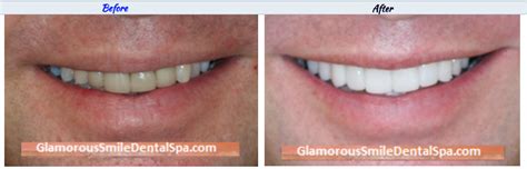 Before and After Dental Smile Gallery - Glamorous Smile Dental SPA