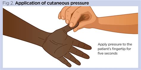 How to measure capillary refill time in patients who are acutely ill | Nursing Times | Nursing ...