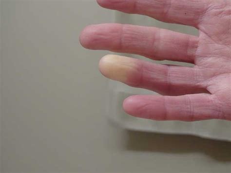 Raynaud’s Disease Diagnosis and Treatments: Don’t Get Left Out in The ...