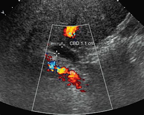 Hepatobiliary Ultrasound | Radiology Key