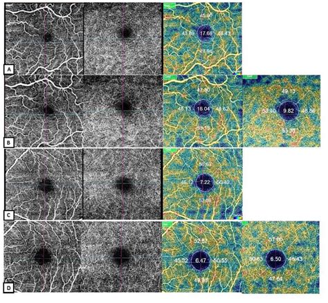 Example of the angiography by optical coherence tomography (OCT-A). The ...