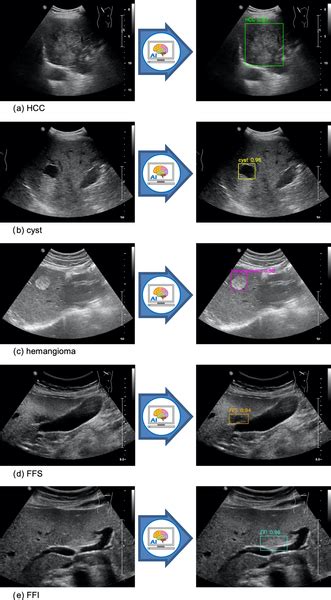 Liver Cancer Ultrasound