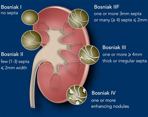 Radiopaedia Bosniak