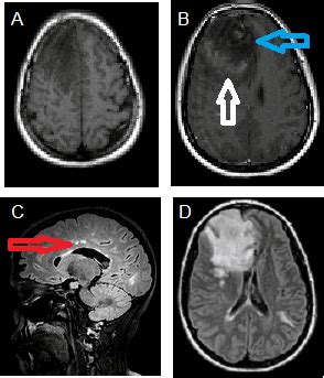 Tumefactive multiple sclerosis - DocNeuro