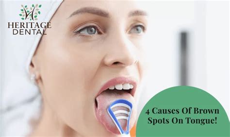 4 Causes Of Brown Spots On Tongue | Know In This Blog!