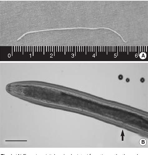 Figure 1 from Subconjuctival Loa loa with Calabar Swelling | Semantic Scholar