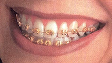 Dentist Practice: What to do with buck teeth braces before and after?