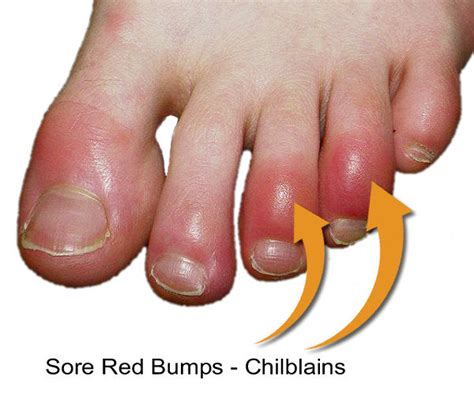 Chilblains on Feet Toes | FIR Socks for Toe Chilblains | TherapySocks.com