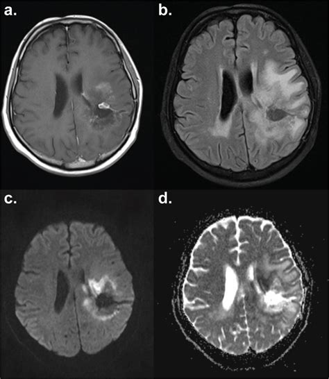 Mri Diffusion Weighted Imaging