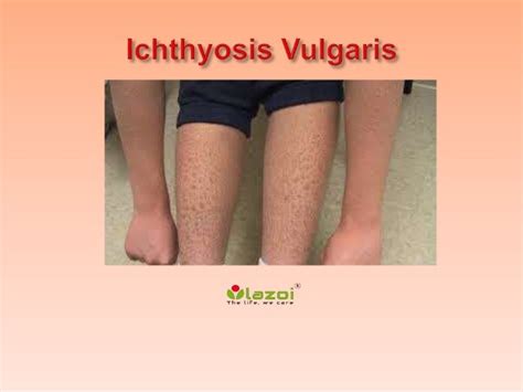 Ichthyosis vulgaris