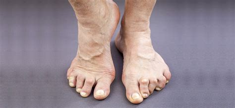 How does Rheumatoid Arthritis affect my feet? | Footcare Scotland