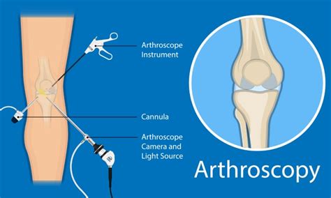 Arthroscopy: Purpose & Procedure – Welcome to SYS Medtech International Pvt. Ltd.