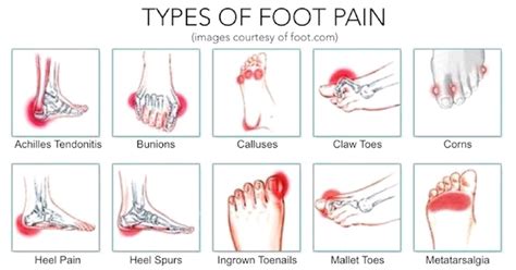 Identifying Foot Pain Types