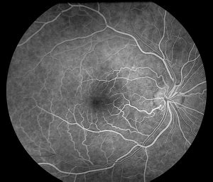 How to interpret fluorescein angiography: 6 types of defects - EyeGuru