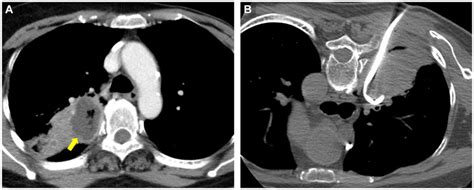 Representative contrast-enhanced CT (CECT) images with liquefied lung... | Download Scientific ...