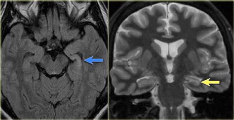 Figure 2 from Association between mesial temporal sclerosis and suicidal behavior in patients ...