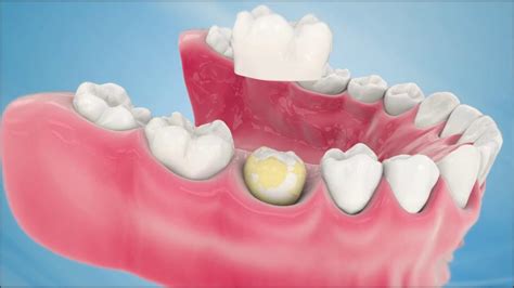 Dental Crown Procedure - YouTube