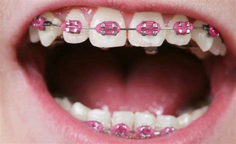 pink braces colors | Braces colors, Teeth braces, Pink braces