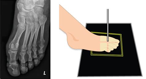 X-Ray Positioning Guide: Toes | Medical Professionals