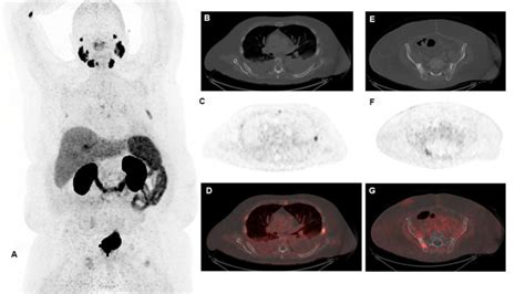 An 82-year-old man with metastatic prostate cancer, but with limited ...