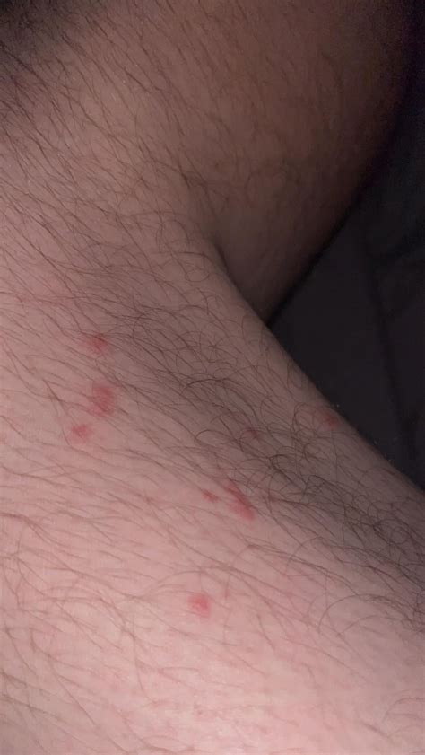 Are these bed bugs bites? : r/bugbites