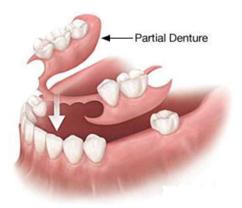 Replacing Missing Teeth: Your Options | Knoxville Family Dentistry