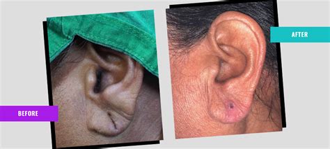 Repair of Large Ear Holes in Delhi