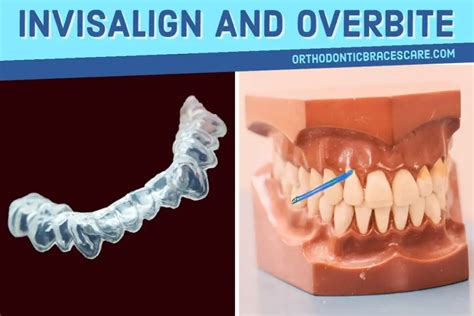 Can Invisalign Really Fix An Overbite - Orthodontic Braces Care