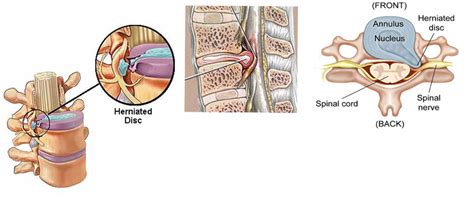 s1 nerve root | Neurology Update