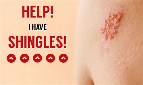 How do You Get Shingles & How to Cure Shingles in Three Days - SKREC News