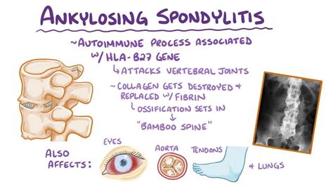 Ankylosing spondylitis: Video, Anatomy & Definition | Osmosis