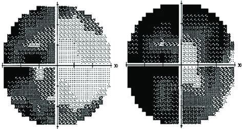 Visual field examination revealed left-side homonymous hemianopsia. | Download Scientific Diagram