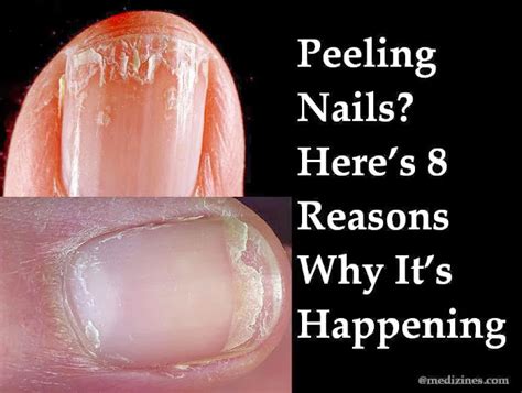 Free Health Tips | Good Nutrition | Healthy Diet Child: Peeling Nails ...