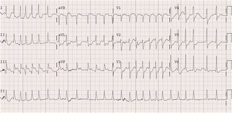 Dr. Smith's ECG Blog: Atrial Fibrillation with RVR and Inferoposterior ...