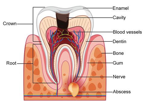 Understanding Tooth Abscesses: Causes, Symptoms, and Treatment