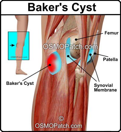 Baker’s Cyst Treatment | OSMO Patch UK