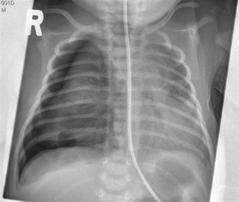 Rare and unexpected complication after a malpositioned nasogastric tube in a neonate | BMJ Case ...