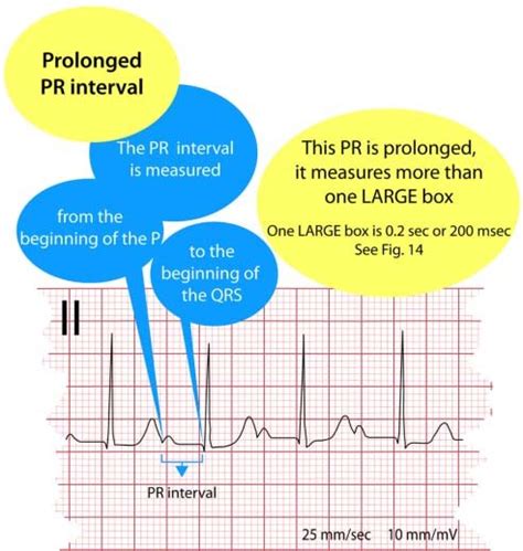 Electrocardiogram, prolonged PR interval. Figure 14. Electrocardiogram,... | Download Scientific ...