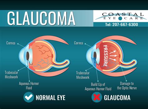 Glaucoma Diagnosis & Treatment for Bangor, ME – Coastal Eye Care