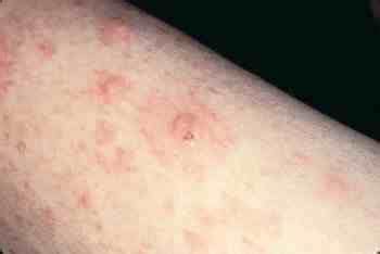 allopurinol rash - pictures, photos