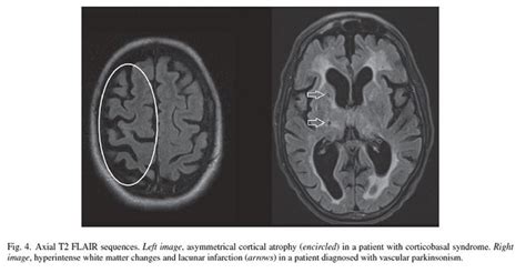 Prometedor avance: Investigadores logran revertir síntomas del Parkinson con injertos de células ...