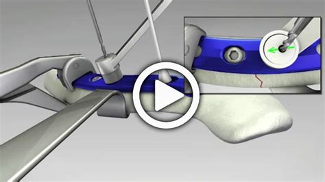 Locking Superior Midshaft and Anterior Clavicle Plates Surgical Technique | Acumed