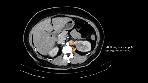 Ultimate Radiology : CASE OF BILATERAL PYELONEPHRITIS