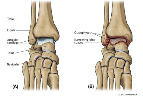 What Is Ankle Arthritis? - MyAnkle | Ankle Arthritis Surgeon London