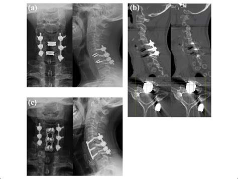 A patient who underwent revision surgery after cervical arthroplasty ...