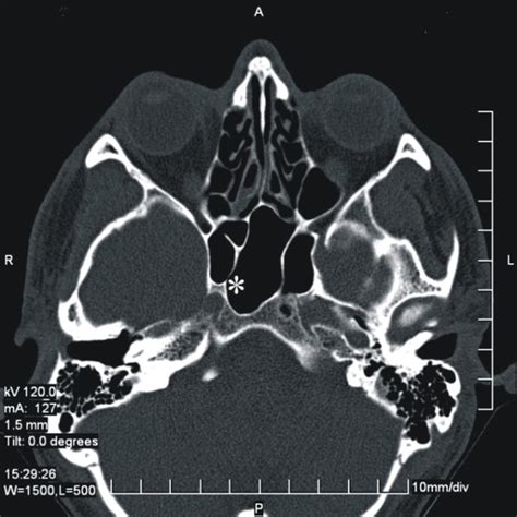 Endoscopic intraoperative endo-sphenoidal view of the right sphenoid ...