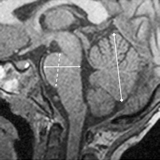 Ectopic neurohypophysis in an 11-year-old girl with FA-G Fanconi... | Download Scientific Diagram