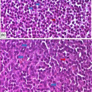 The re-examination of the cervical lymph node biopsy showed at ...