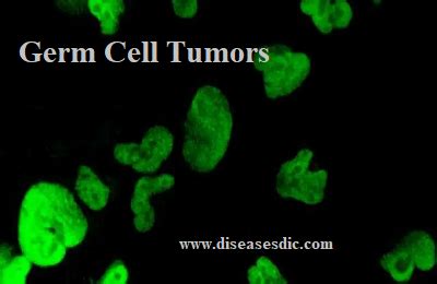 Germ Cell Tumors – Symptoms, Treatment, and Prevention.