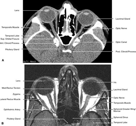 Radiology Anatomy Images : ORBIT CT SCAN ANATOMY